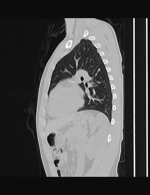 Calcifying pulmonary metastases (Radiopaedia 33359-34396 Sagittal lung window 24).jpg