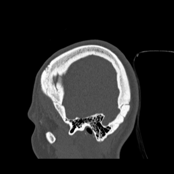 Calvarial osteoma (Radiopaedia 36520-38079 Sagittal bone window 17).jpg