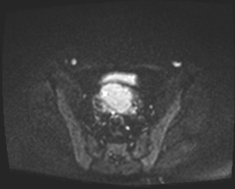 Cancer cervix - stage IIb (Radiopaedia 75411-86615 Axial DWI 48).jpg
