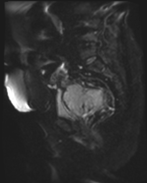 Cancer cervix - stage IIb (Radiopaedia 75411-86615 Sagittal DWI 36).jpg