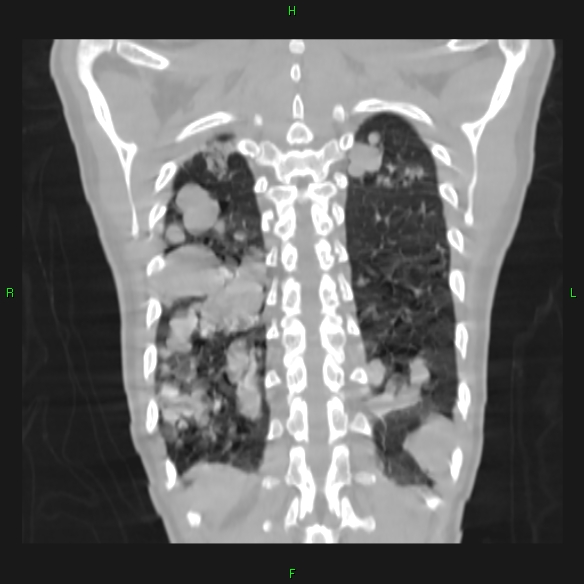 File:Cannon ball metastases - synovial sarcoma (Radiopaedia 26135-26271 Coronal lung window 19).jpg
