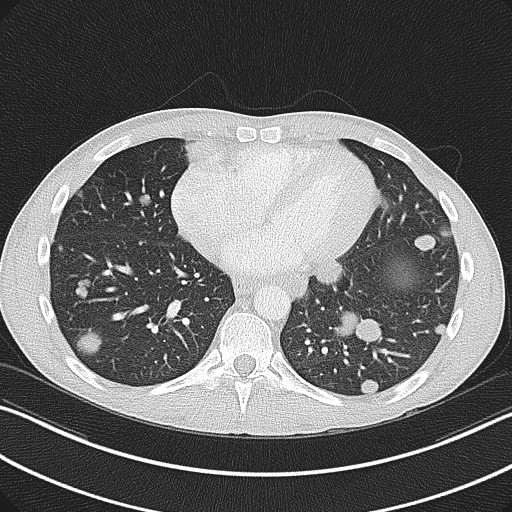 Cannonball metastases - testicular choriocarcinoma (Radiopaedia 84510-99891 Axial lung window 67).jpg