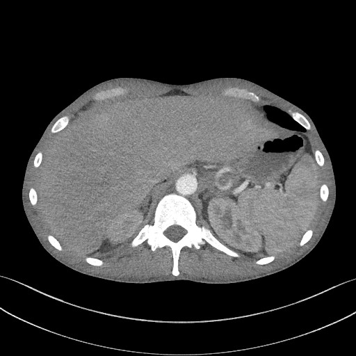 Cannonball metastases - testicular choriocarcinoma (Radiopaedia 84510-99891 B 101).jpg
