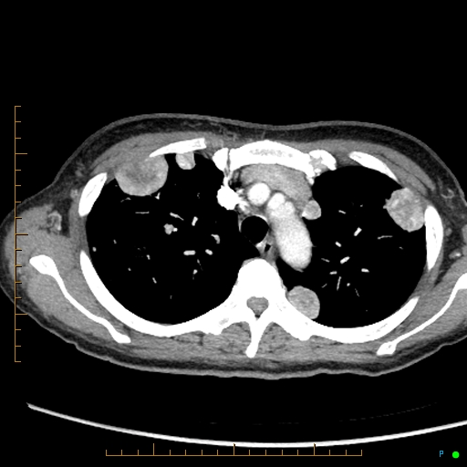 Canonball lung metastasis (Radiopaedia 77634-89837 B 22).jpg