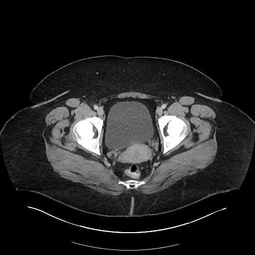 Carcinoid tumor - terminal ileum (Radiopaedia 60931-68739 A 126).jpg