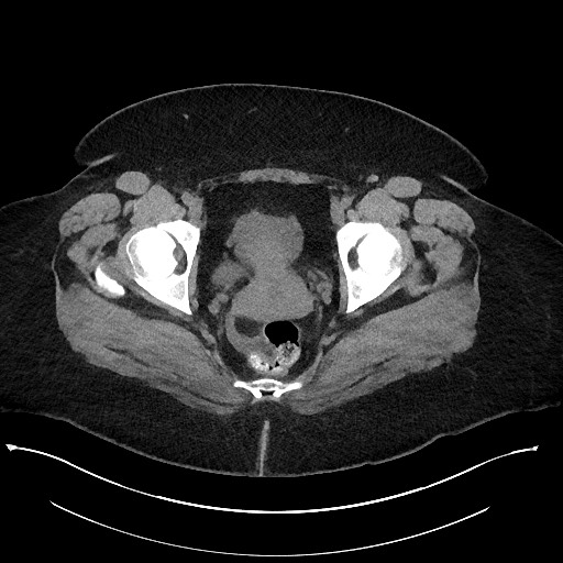 Carcinoid tumor - terminal ileum (Radiopaedia 60931-68740 Axial non-contrast 116).jpg