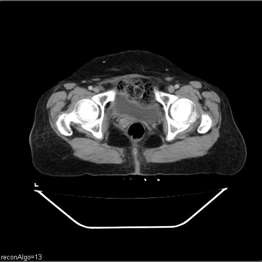 File:Carcinoma cervix- recurrence (Radiopaedia 34702-36137 B 50).jpg