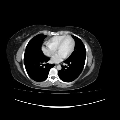 Carcinoma colon - hepatic flexure (Radiopaedia 19461-19493 A 2).jpg