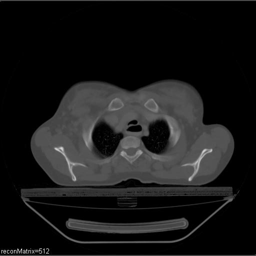 File:Carcinoma of esophagus (Radiopaedia 27356-27550 Axial bone window 28).jpg