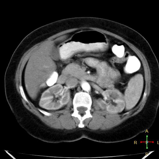 File:Carcinoma of sigmoid colon (Radiopaedia 23071-23100 C+ arterial phase 10).jpg
