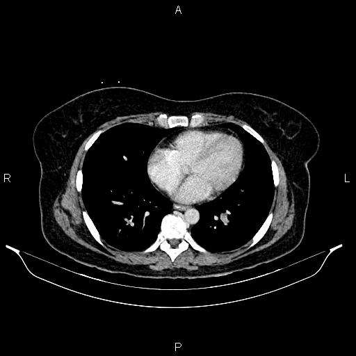 Carcinoma of uterine cervix (Radiopaedia 85861-101700 A 24).jpg