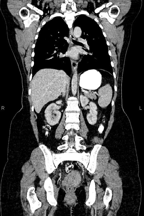 Carcinoma of uterine cervix (Radiopaedia 85861-101700 C 36).jpg