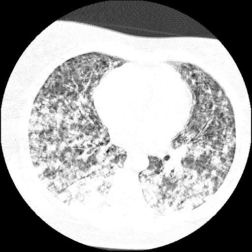 Cardiac angiosarcoma (Radiopaedia 66010-75181 Axial lung window 44).jpg