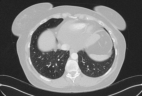 Cardiac sarcoidosis (Radiopaedia 74548-85534 Axial lung window 70).jpg