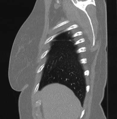 Cardiac sarcoidosis (Radiopaedia 74548-85534 Sagittal lung window 82).jpg