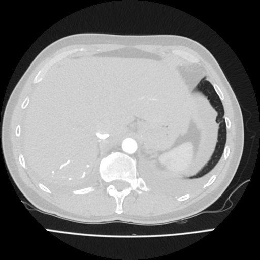 Cardiac tamponade (Radiopaedia 78607-91368 Axial lung window 87).jpg