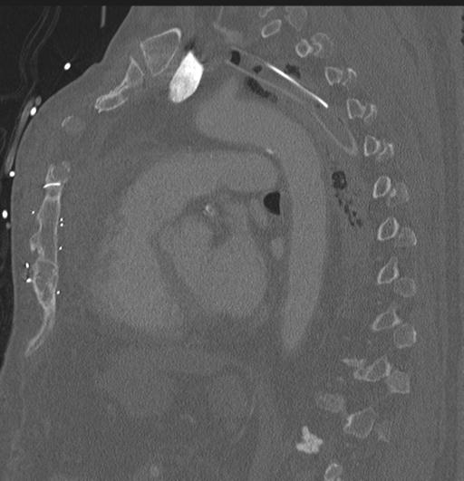 Cardiac trauma (Radiopaedia 32874-33858 Sagittal bone window 20).jpg