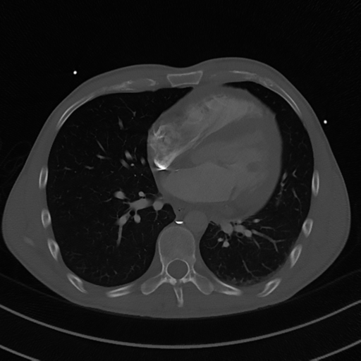 Cardiac tumor - undifferentiated pleomorphic sarcoma (Radiopaedia 45844-50134 Axial bone window 41).png