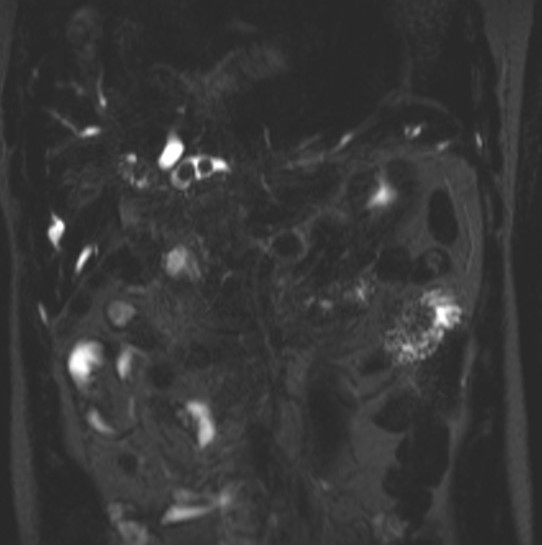 File:Caroli disease with medullary sponge kidney and nephrocalcinosis (Radiopaedia 10805-11251 D 1).jpg
