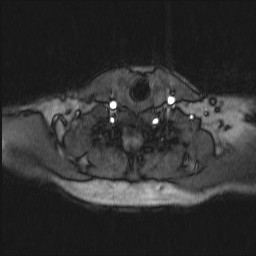 Carotid artery dissection (Radiopaedia 28441-28689 Axial MRA 19).jpg