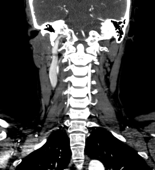File:Carotid body tumor (Radiopaedia 39845-42300 C 66).jpg