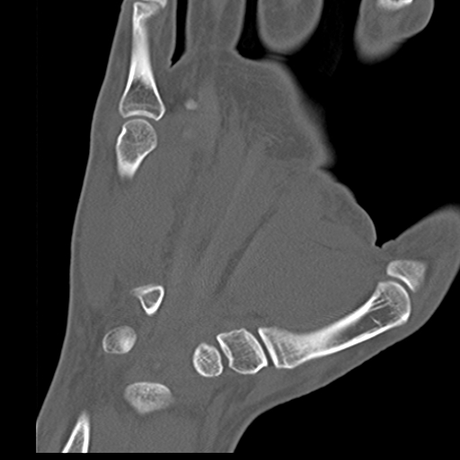 File:Carpo-metacarpal fracture-dislocations with hamatum split fracture (Radiopaedia 18482-18343 Coronal bone window 15).jpg