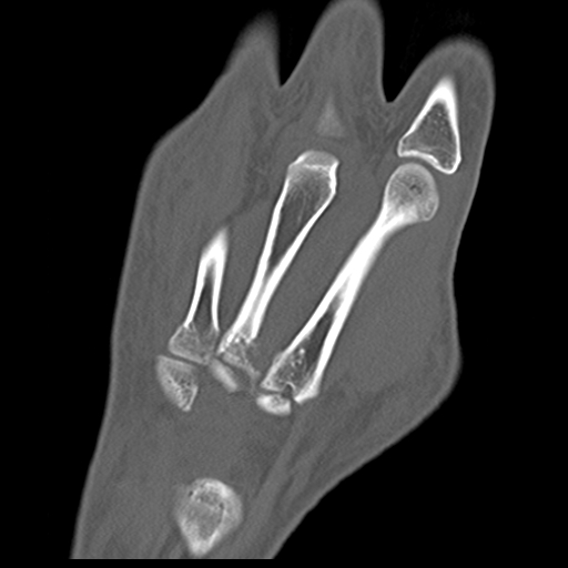 File:Carpo-metacarpal fracture-dislocations with hamatum split fracture (Radiopaedia 18482-18343 Coronal bone window 6).jpg