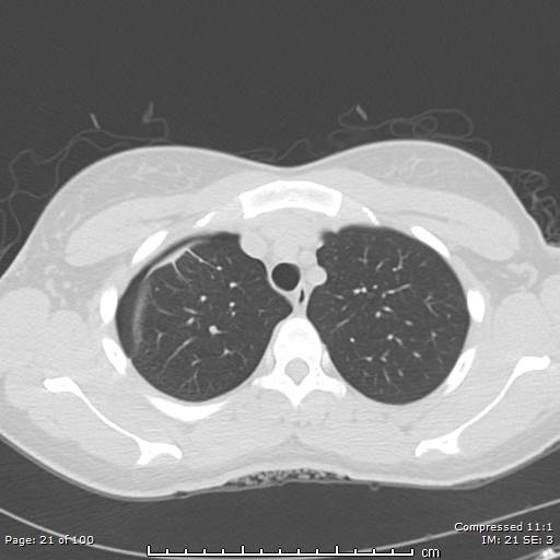 Catamenial pneumothorax (Radiopaedia 54382-60600 Axial non-contrast 21).jpg