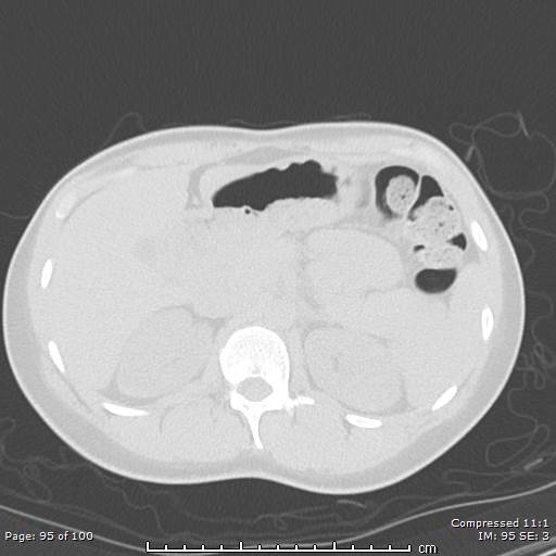 Catamenial pneumothorax (Radiopaedia 54382-60600 Axial non-contrast 95).jpg