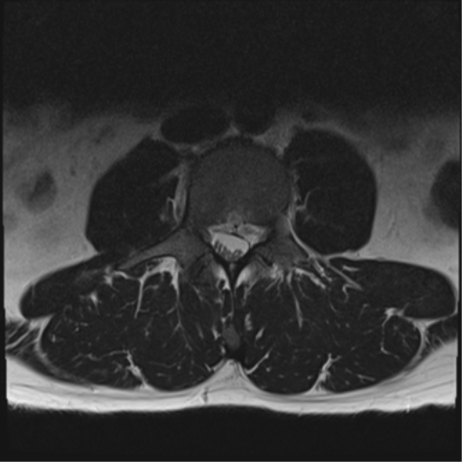 File:Cauda equina syndrome (Radiopaedia 53615-59672 Axial T2 22).png