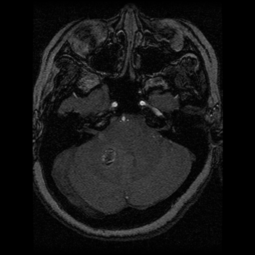 Cavernoma, DVA and right ICA aneurysm (Radiopaedia 33890-35072 E 80).png
