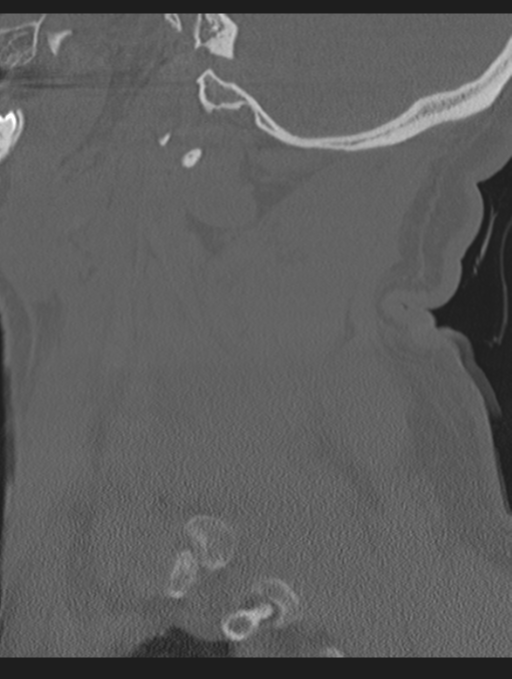 Cavernoma of cervical cord (Radiopaedia 50838-56346 Sagittal bone window 19).png