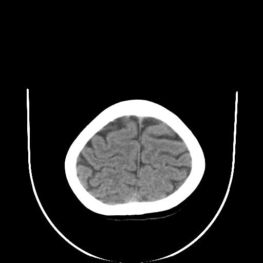 File:Cavernoma with developmental venous anomaly (Radiopaedia 22470-22506 non-contrast 30).jpg