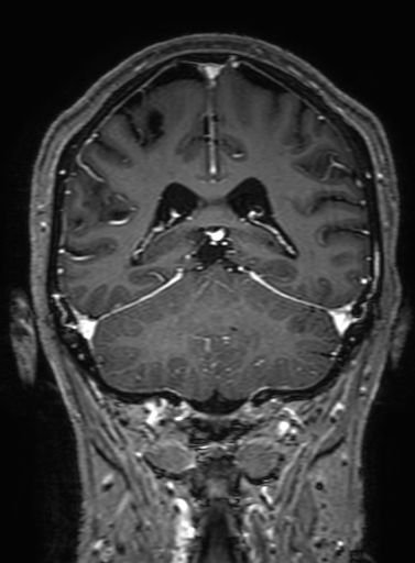 Cavernous hemangioma of the cerebellar falx (Radiopaedia 73025-83724 Coronal T1 C+ 254).jpg