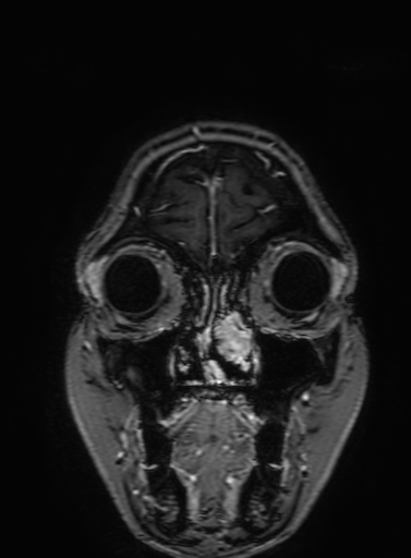 Cavernous hemangioma of the cerebellar falx (Radiopaedia 73025-83724 Coronal T1 C+ 40).jpg
