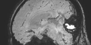 Cavernous hemangioma of the cerebellar falx (Radiopaedia 73025-83724 Sagittal BOLD 108).jpg