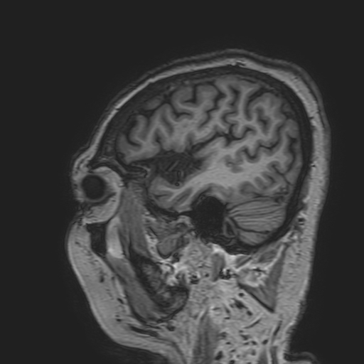 File:Cavernous hemangioma of the cerebellar falx (Radiopaedia 73025-83724 Sagittal T1 41).jpg