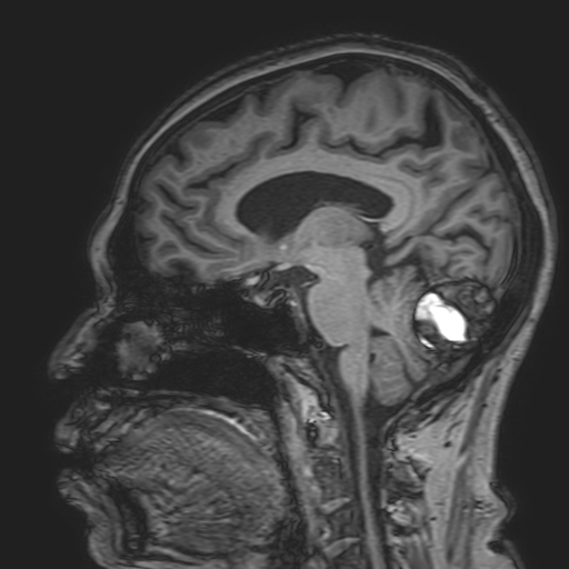 File:Cavernous hemangioma of the cerebellar falx (Radiopaedia 73025-83724 Sagittal T1 97).jpg
