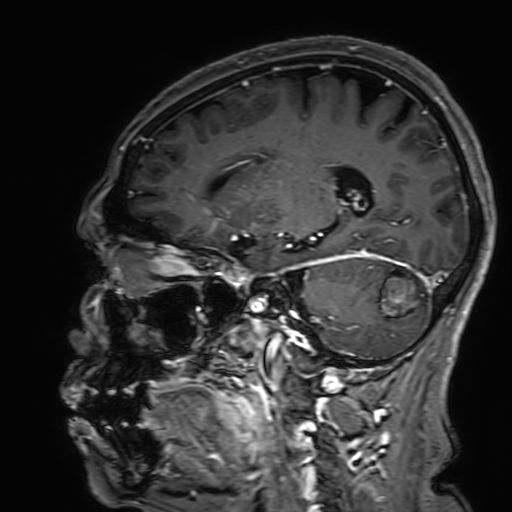 Cavernous hemangioma of the cerebellar falx (Radiopaedia 73025-83724 Sagittal T1 C+ 78).jpg