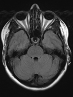 File:Cavernous malformation (cavernous angioma or cavernoma) (Radiopaedia 36675-38237 Axial T2 FLAIR 6).png
