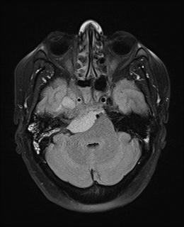 File:Cavernous sinus meningioma (Radiopaedia 63682-72367 Axial FLAIR 7).jpg