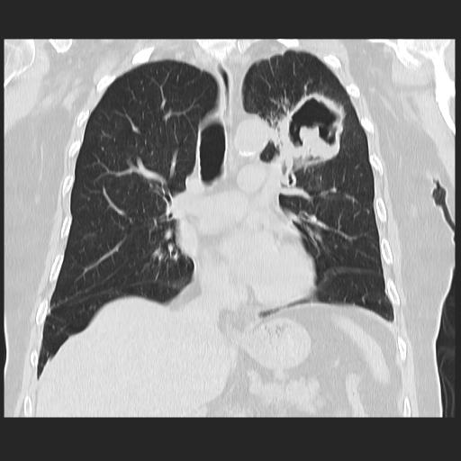 File:Cavitating pulmonary metastases (Radiopaedia 89545-106544 Coronal lung window 21).jpg