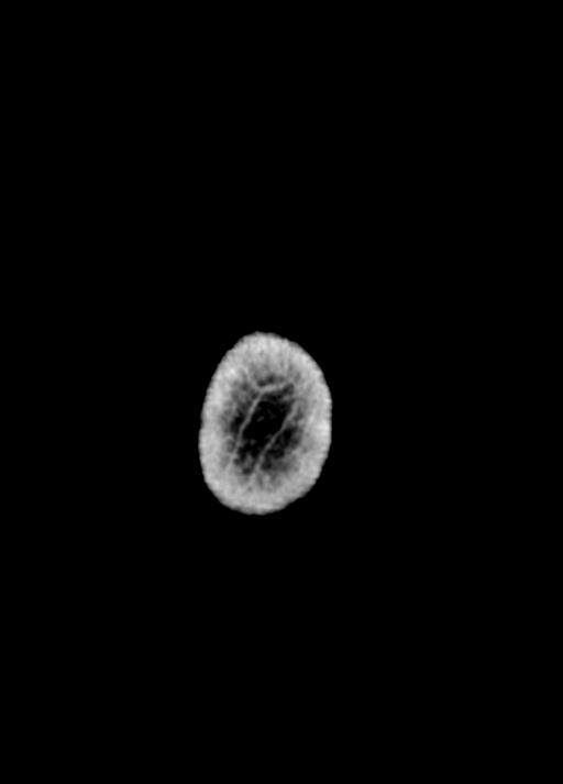 Cavum septum pellucidum and cavum vergae (Radiopaedia 77797-90060 Axial Brain Window 110).jpg