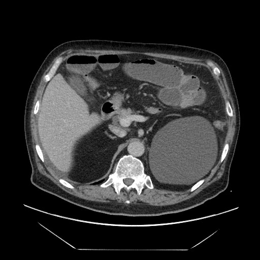 Cecal adenocarcinoma (Radiopaedia 64871-73817 A 25).jpg