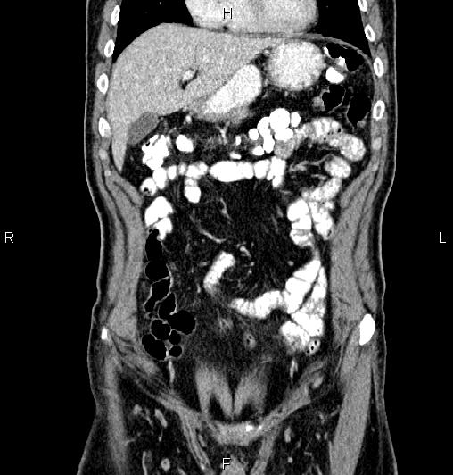 Cecal adenocarcinoma (Radiopaedia 85324-100916 D 17).jpg