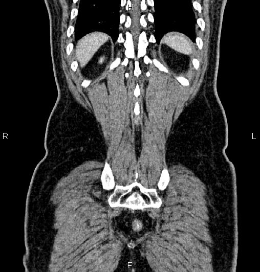 Cecal adenocarcinoma (Radiopaedia 85324-100916 D 60).jpg