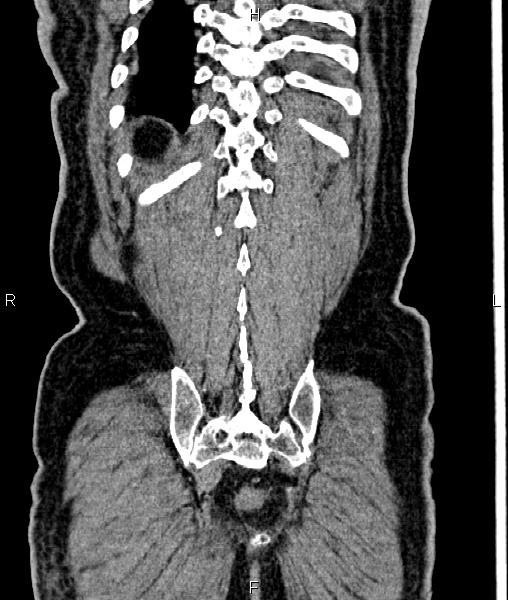 Cecal cancer with appendiceal mucocele (Radiopaedia 91080-108651 D 65).jpg