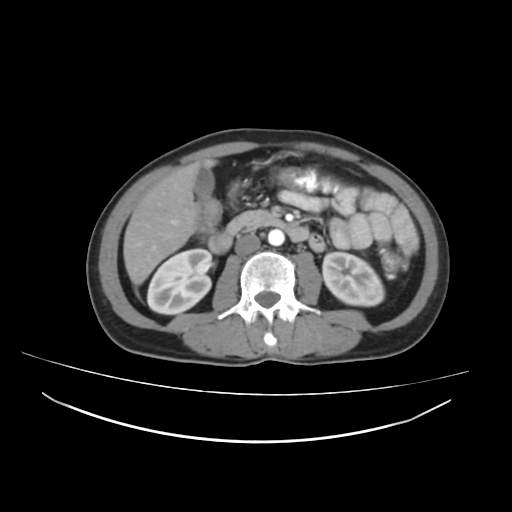 Cecal carcinoma with local lymphadenopathy (Radiopaedia 31428-32240 A 23).jpg