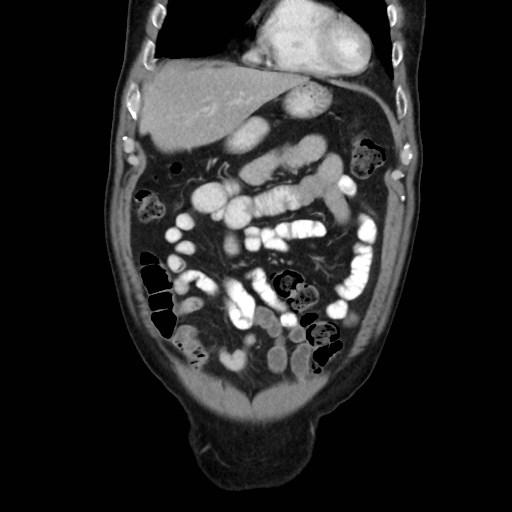Cecal mass causing appendicitis (Radiopaedia 59207-66531 B 13).jpg
