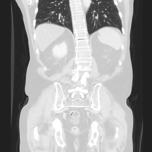 Cecal volvulus (Radiopaedia 75378-86620 Coronal lung window 102).jpg